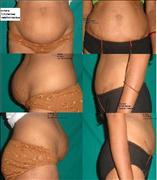 Before After Pictures,Cosmetic surgery,Delhi,Tummy Tuck, abdominoplasty 1